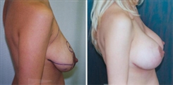 Breast Lift Patient Before & After Photo 1