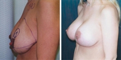 Breast Lift Patient Before & After Photo 1