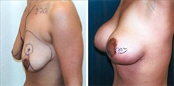 Breast Lift Patient Before & After Photo 1