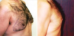 Breast Lift Patient Before & After Photo 1