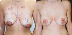 Breast Lift Patient Before & After Photo 1