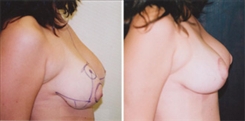 Breast Lift Patient Before & After Photo 1