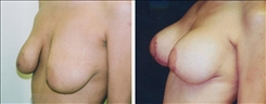 Breast Lift Patient Before & After Photo 1