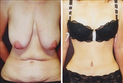 Breast Lift Patient Before & After Photo 1