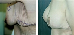 Breast Lift Patient Before & After Photo 1