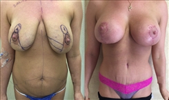 Breast Lift Patient Before & After Photo 1