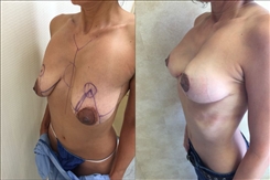 Breast Lift Patient Before & After Photo 1