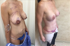 Breast Lift Patient Before & After Photo 1