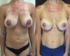 breast-lift-patient-098
