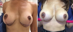 Breast Lift Patient Before & After Photo 1