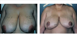 Breast Reduction Patient Before & After Photo 1