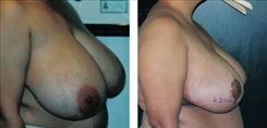 Breast Reduction Patient Before & After Photo 1