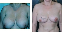 Breast Reduction Patient Before & After Photo 1