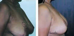 Breast Reduction Patient Before & After Photo 1