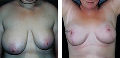 breast-reduction-patient-013
