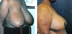 Breast Reduction Patient Before & After Photo 1