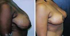 Breast Reduction Patient Before & After Photo 1