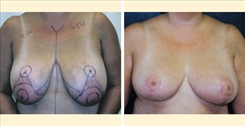 breast-reduction-patient-016