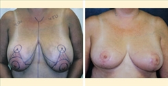 Breast Reduction Patient Before & After Photo 1