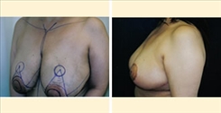 Breast Reduction Patient Before & After Photo 1
