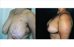 Breast Reduction Patient Before & After Photo 1