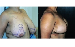 Breast Reduction Patient Before & After Photo 1