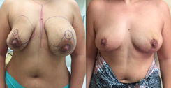 Breast Reduction Patient Before & After Photo 1