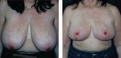 Breast Reduction Patient Before & After Photo 1