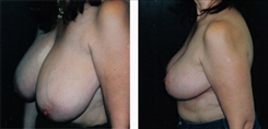 Breast Reduction Patient Before & After Photo 1