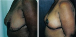 Breast Reduction Patient Before & After Photo 1