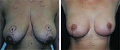 Breast Reduction Patient Before & After Photo 1