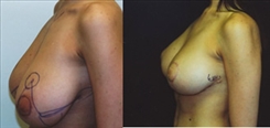 Breast Reduction Patient Before & After Photo 1