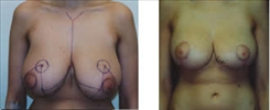 Breast Reduction Patient Before & After Photo 1