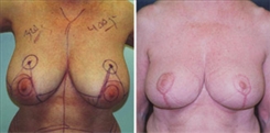 Breast Reduction Patient Before & After Photo 1