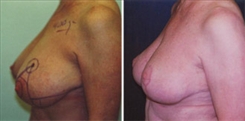 Breast Reduction Patient Before & After Photo 1