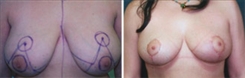 Breast Reduction Patient Before & After Photo 1