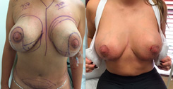 Breast Reduction Patient Before & After Photo 1