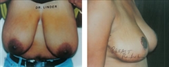 breast-reduction-patient-04
