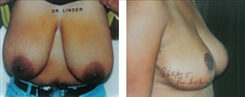 Breast Reduction Patient Before & After Photo 1