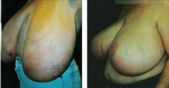 Breast Reduction Patient Before & After Photo 1