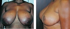 Breast Reduction Patient Before & After Photo 1