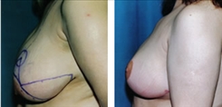 Breast Reduction Patient Before & After Photo 1