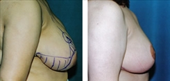 Breast Reduction Patient Before & After Photo 1