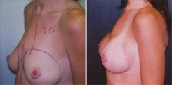 Pectus Carinatum Breast Patient Before & After Photo 1