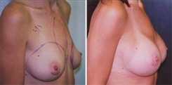 Breast Procedures Patient Before & After Photo 1