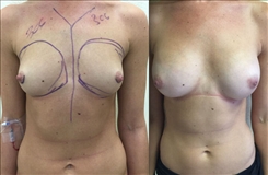 Breast Procedures Patient Before & After Photo 1