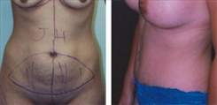 Combination Procedures & Body Sculpting Patient Before & After Photo 1