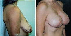 Body Procedures Patient Before & After Photo 1