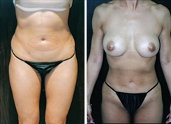 Combination Procedures & Body Sculpting Patient Before & After Photo 1