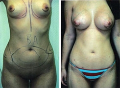 Combination Procedures & Body Sculpting Patient Before & After Photo 1